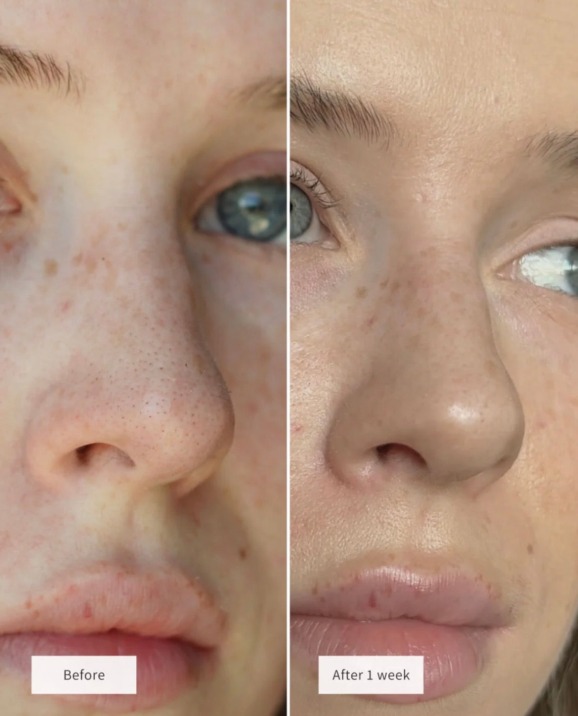 DermaPure™ | Sollievo rapido dall'acne