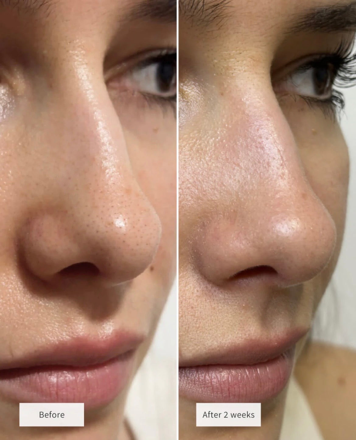 DermaPure™ | Sollievo rapido dall'acne